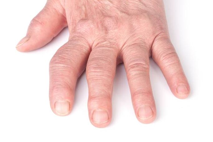 deforméiert Arthrose op den Hänn