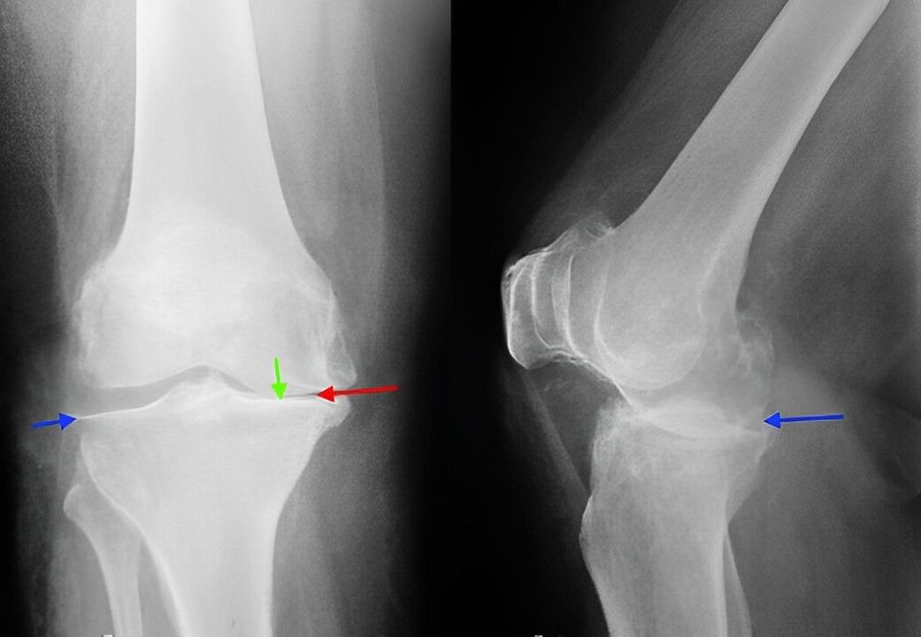 Röntgen vun der Arthrosis vum Kniegelenk