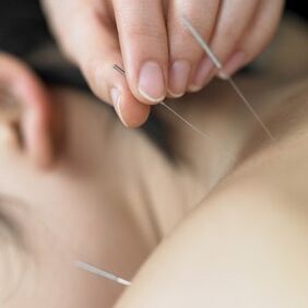Akupuncture