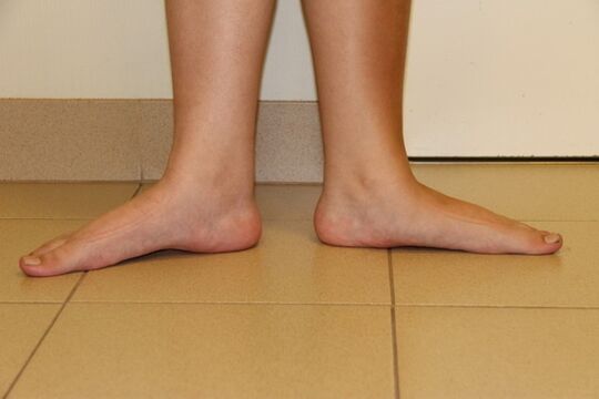 Heiansdo ass d'Ursaach vun den Hals Arthrosis flaach Féiss