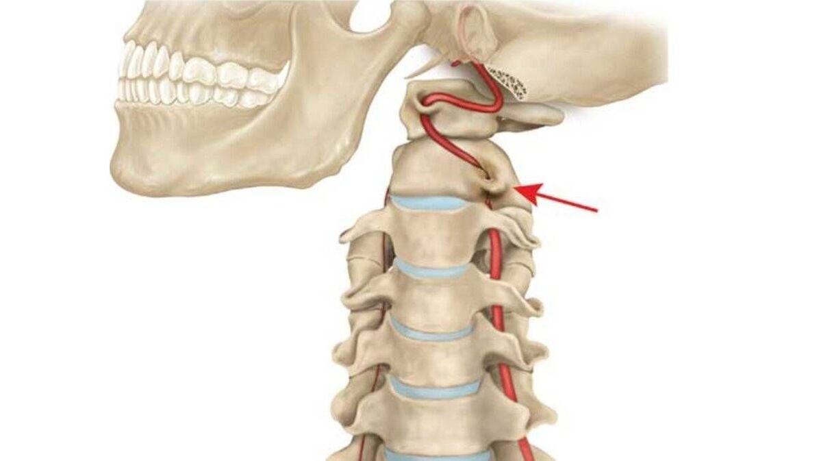 osteochondrosis vun der cervical Wirbelsail
