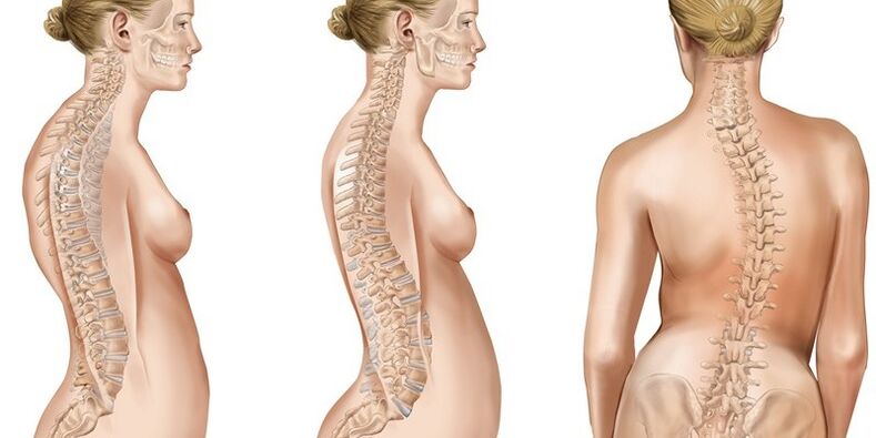 Scoliose vun der thoracic Wirbelsäule provozéiert Péng an de Schëllerblades