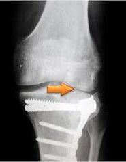 Arthrosis vum Kniegelenk