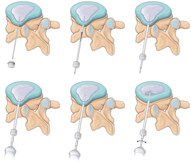 Chirurgie fir Réckschmerzen