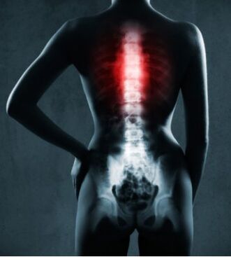 Dee betraffene Beräich vun der Wirbelsäule mat thorakaler Osteochondrose