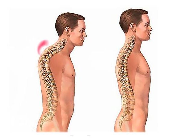 Spinal Kyphose